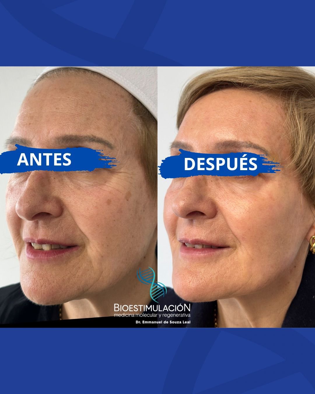 Resultado de tratamiento facial - Bioestimulación